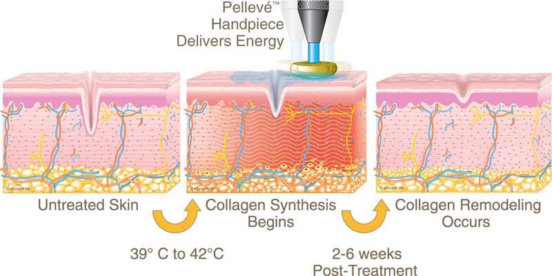 Pelleve diagram