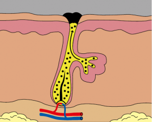 acne fig 2