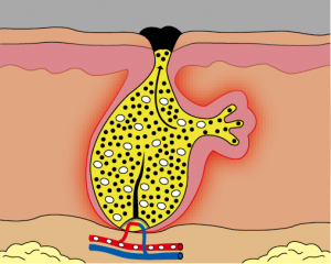 acne fig 3