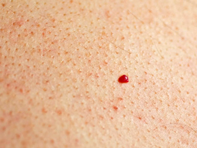 Skin Tag and Blemish Removal - S3 Skin and Laser