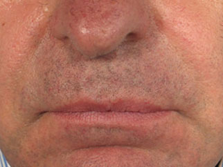 dermal fillers after