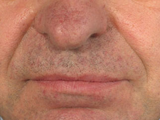 dermal fillers before