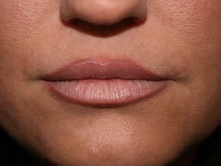 dermal fillers after