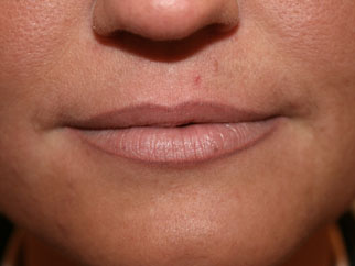 dermal fillers before